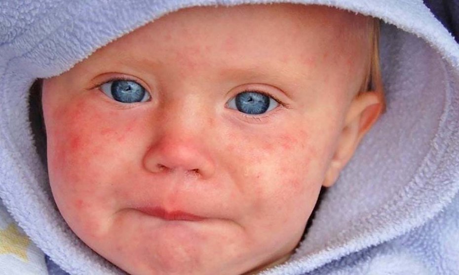 ALERTA: Repunte de sarampión y meningitis en niños